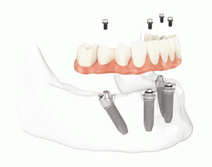 lower-jaw Dental Implants Peoria IL