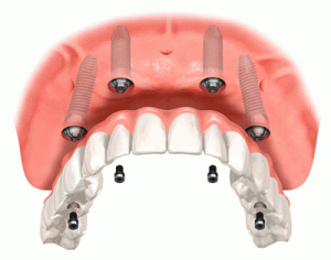An illustration of upper jaw dental impants